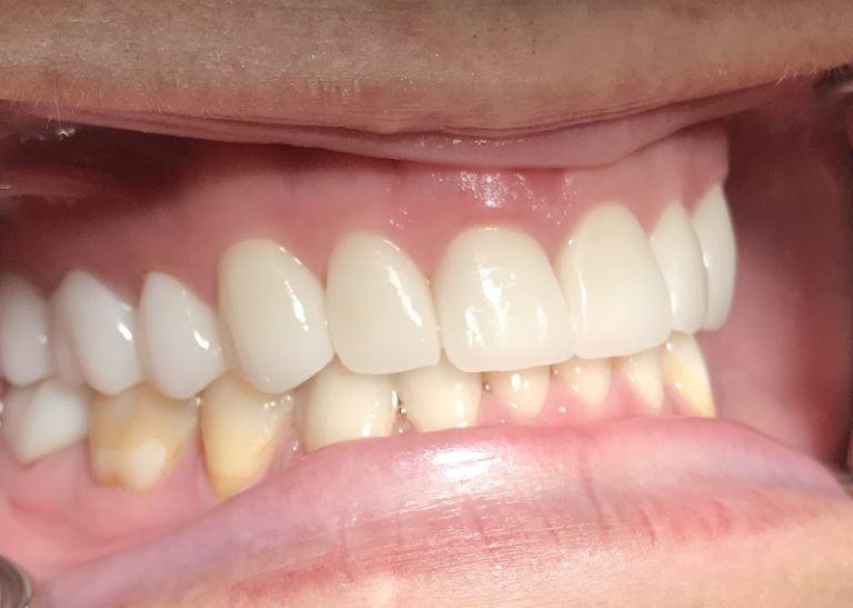 Precision Dental - Dentist At 3885 S Val Vista Dr Suite 106, Gilbert, AZ 85297 4 photo 26568c31 ee7d 459d b311 bb5353983a1e 768x547