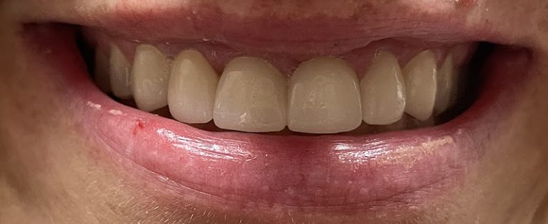 Powell Dental Group - Dentist At 39 Clairedan Dr, Powell, OH 43065 2 photo 59e55478 1426 429a a7d6 0b250b9819d2 768x314