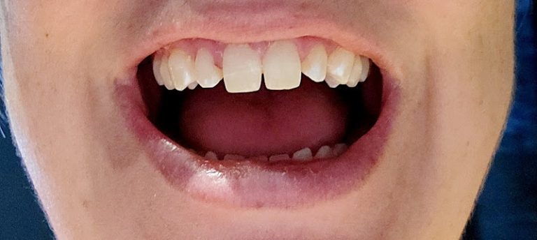 Wake Dental - Cary - Dentist At 3100 NC-55 STE 201, Cary, NC 27519 3 photo 73ff7e9c fbbc 478e 8c08 4ff71ccec372 768x344