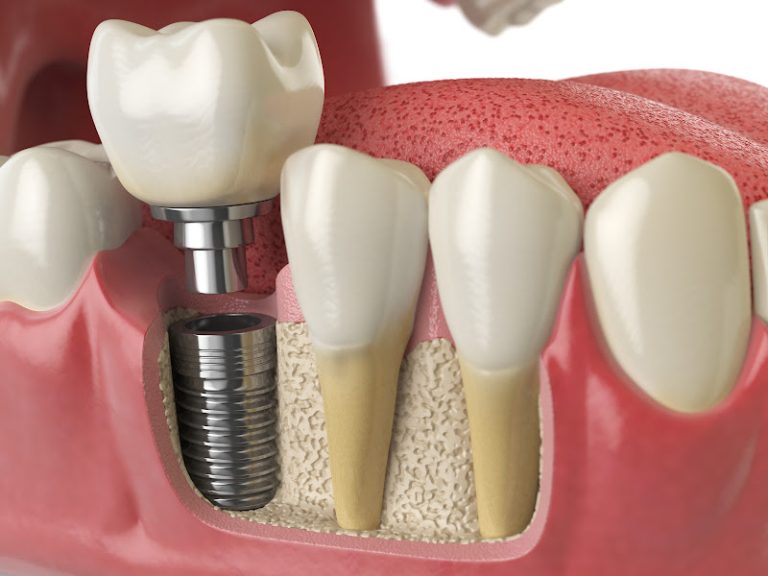 Villages Smiles | Dentist The Villages Florida - Cosmetic dentist At 4060 FL-44 Suite 2B, Wildwood, FL 34785 3 photo 7d832af6 c41f 49f3 a0e2 5e4a49116875 768x576