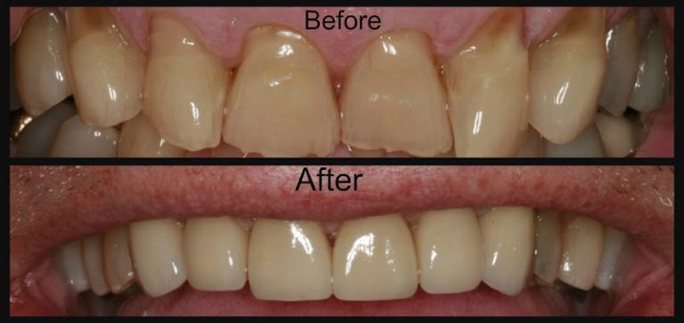 Bridgeview Dental - Dentist At 212 Ohio St, Oshkosh, WI 54902 3 photo 8a8d9407 3234 4894 9feb 05a81cb922b5 768x363