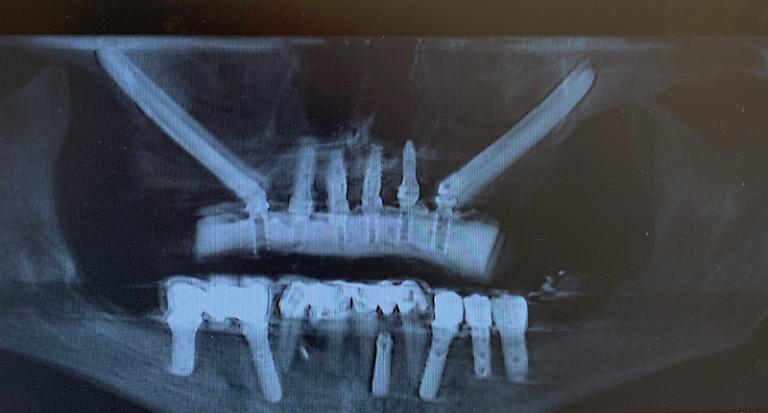 Texas Implant & Dental Center of Fort Worth - Dental implants provider At 1414 Texas St, Fort Worth, TX 76102 4 photo c9a1c98f d045 4639 ae8e c91edc1d4dd6 768x413