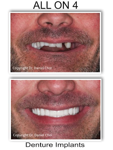 North Texas Dental Surgery Wisdom Teeth and Denture Implant Center