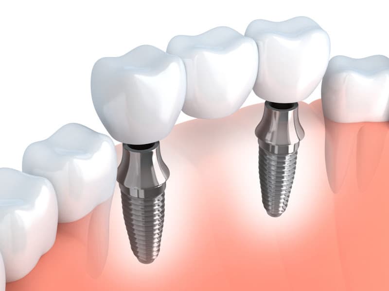 Bismarck Advanced Dental and Implants — photo 2
