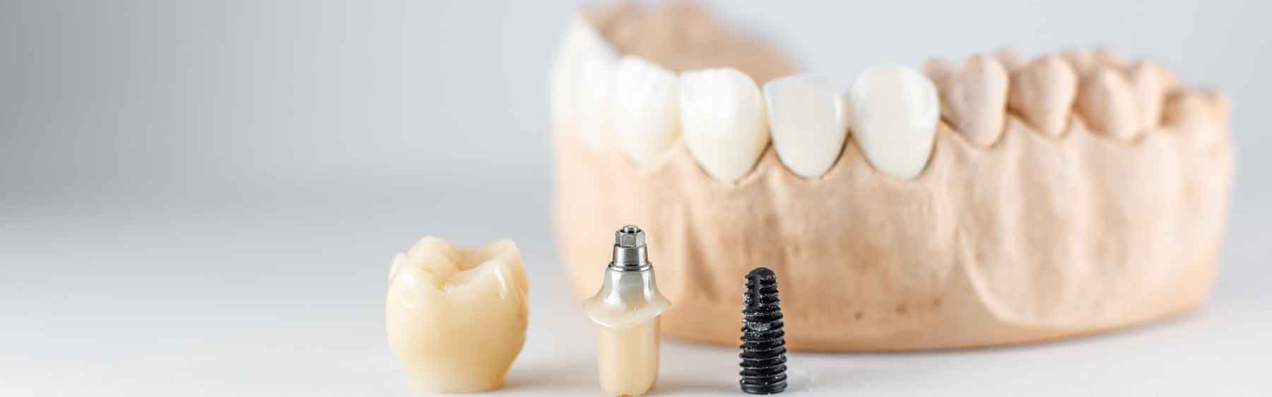 Dental implants periodontist near me