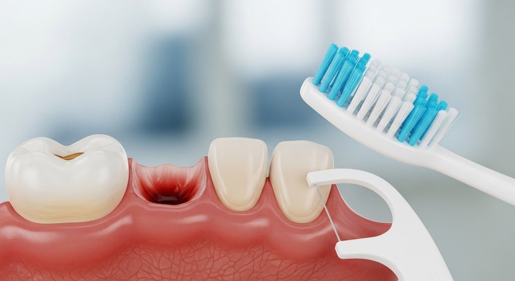 Understanding, Preventing, and Treating Periodontal Disease